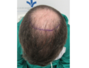Before CHRC Hair Restoration Patient