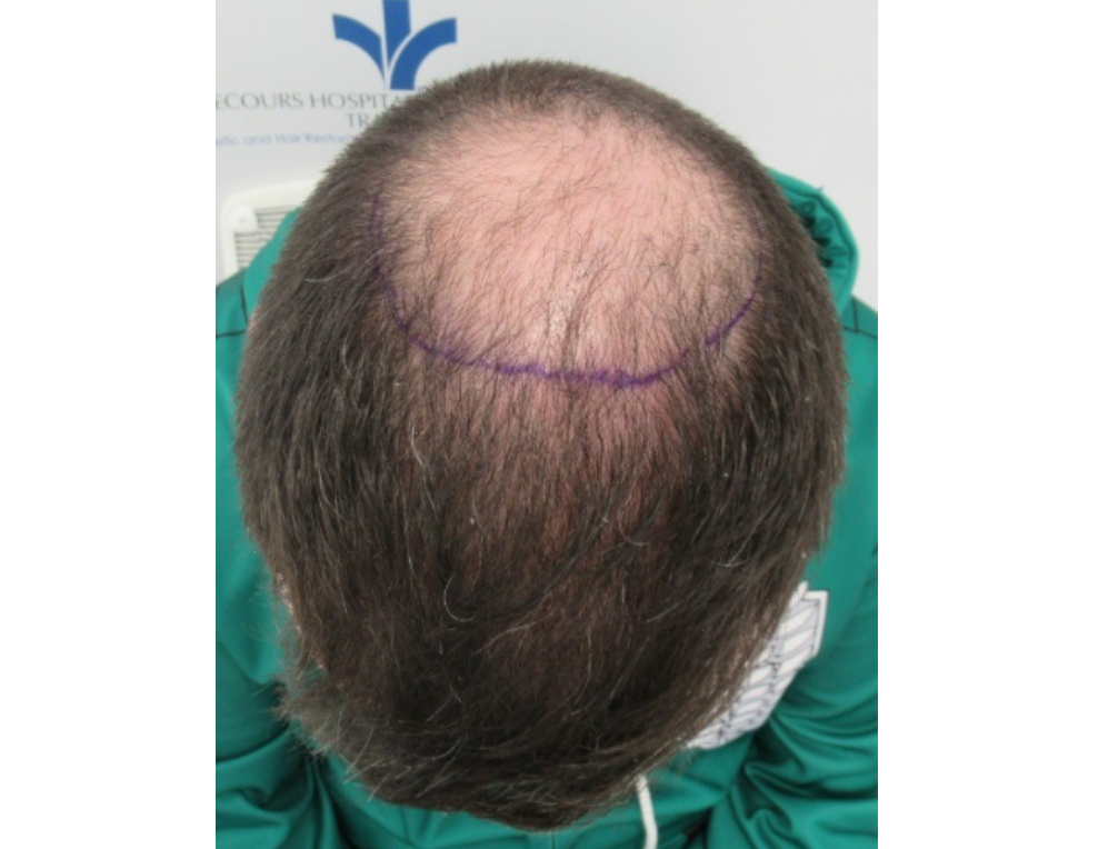 Before CHRC Hair Restoration Patient